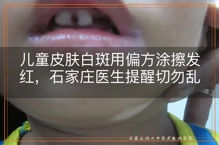 儿童皮肤白斑用偏方涂擦发红,石家庄医生提醒切勿乱尝试
