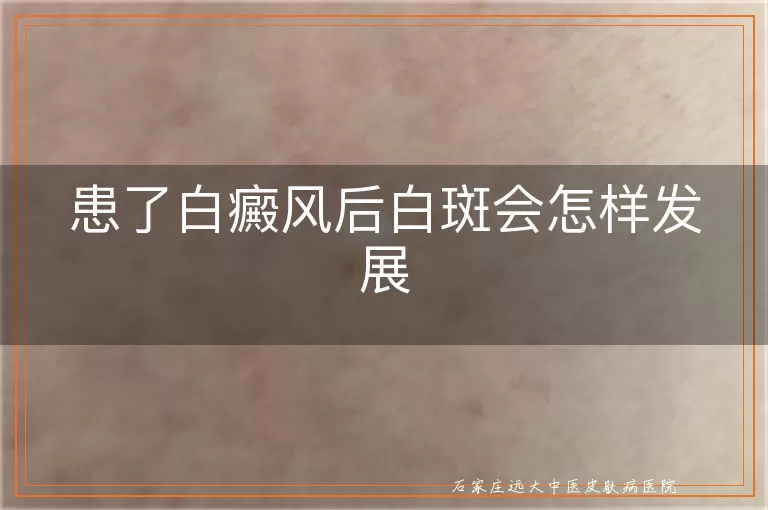 患了白癜风后白斑会怎样发展