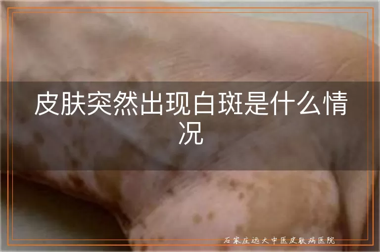 皮肤突然出现白斑是什么情况