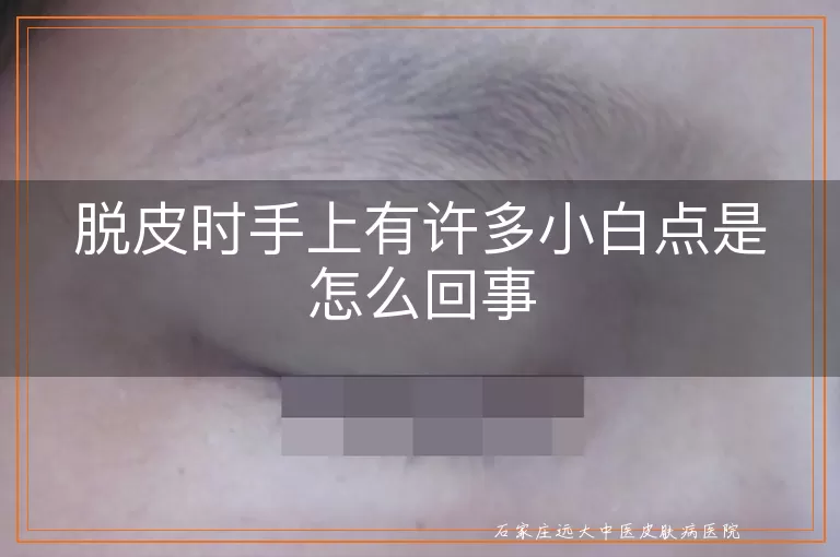 脱皮时手上有许多小白点是怎么回事