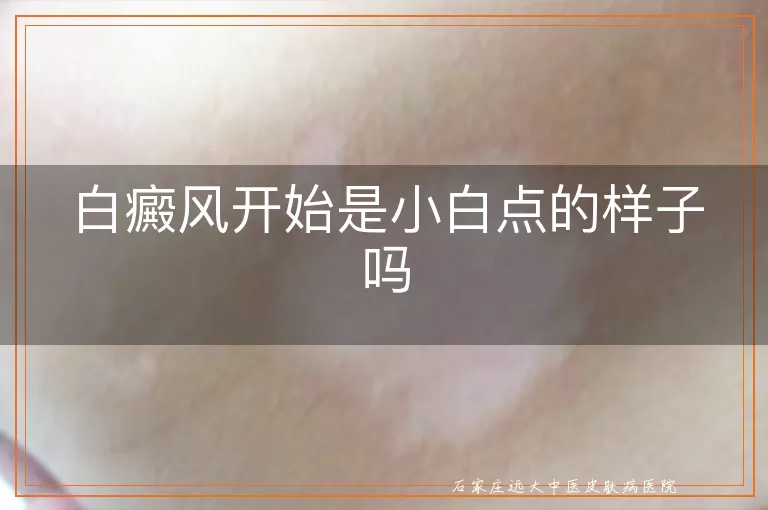白癜风开始是小白点的样子吗