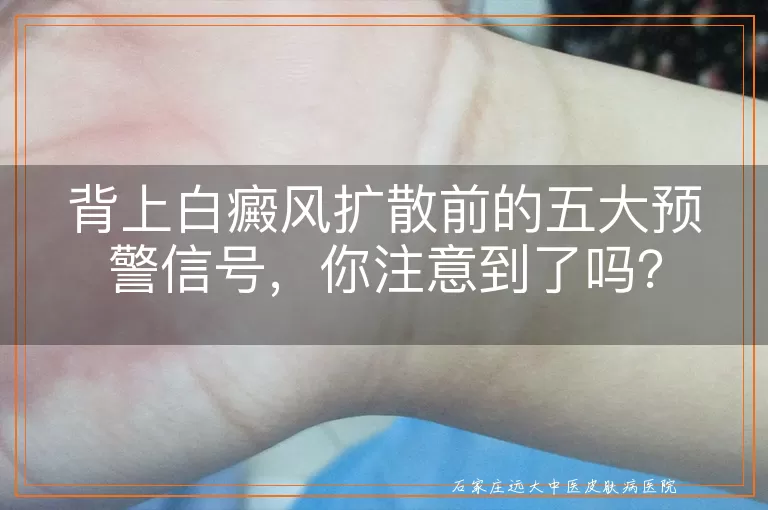 背上白癜风扩散前的五大预警信号，你注意到了吗？