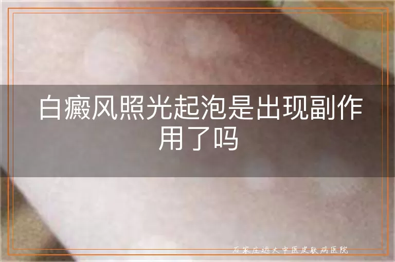 白癜风照光起泡是出现副作用了吗