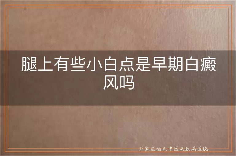 腿上有些小白点是早期白癜风吗