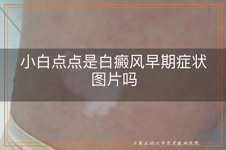 小白点点是白癜风早期症状图片吗