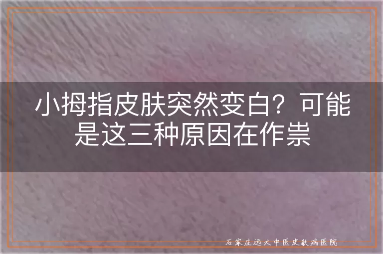 小拇指皮肤突然变白？可能是这三种原因在作祟