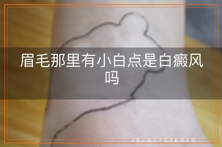 眉毛那里有小白点是白癜风吗
