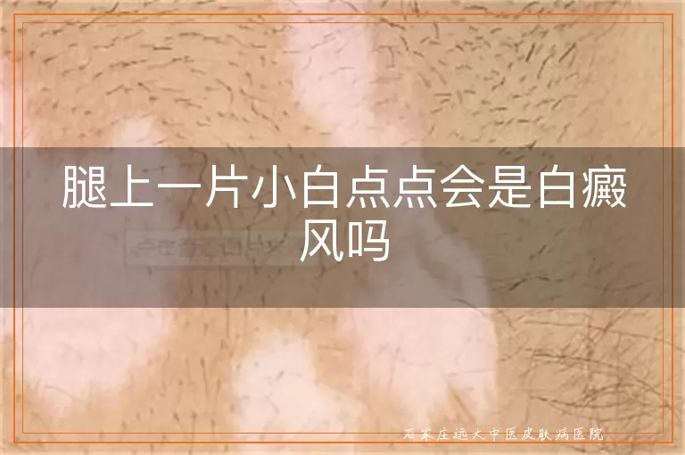 腿上一片小白点点会是白癜风吗