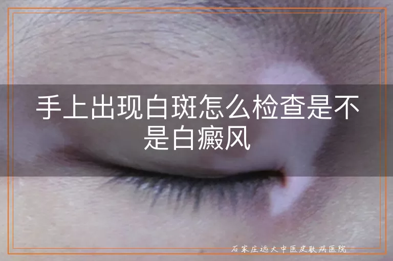 手上出现白斑怎么检查是不是白癜风