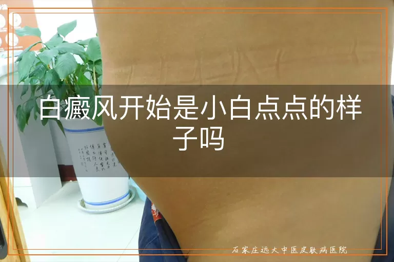 白癜风开始是小白点点的样子吗