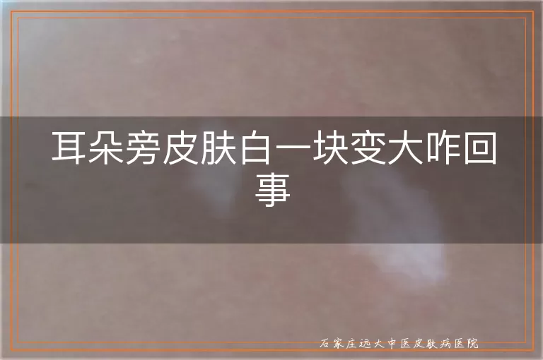 耳朵旁皮肤白一块变大咋回事