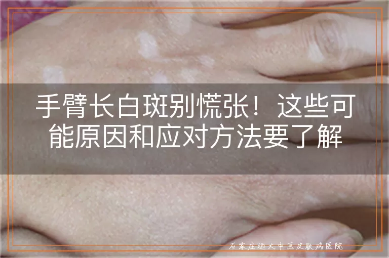 手臂长白斑别慌张!这些可能原因和应对方法要了解