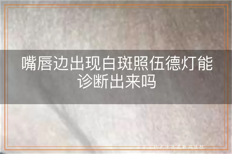 嘴唇边出现白斑照伍德灯能诊断出来吗