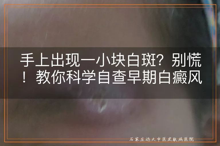 手上出现一小块白斑?别慌!教你科学自查早期白癜风