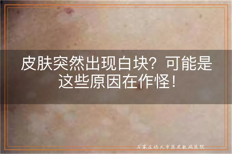皮肤突然出现白块?可能是这些原因在作怪!