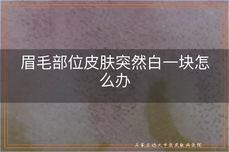 眉毛部位皮肤突然白一块怎么办