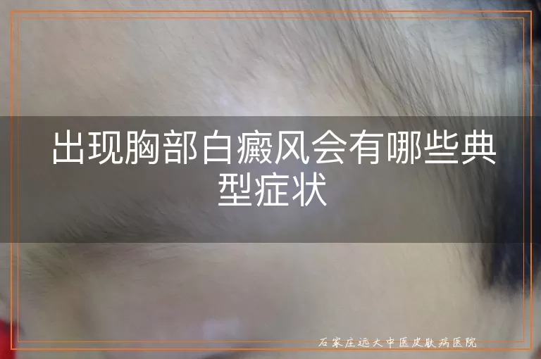 出现胸部白癜风会有哪些典型症状
