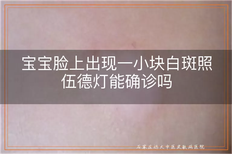 宝宝脸上出现一小块白斑照伍德灯能确诊吗