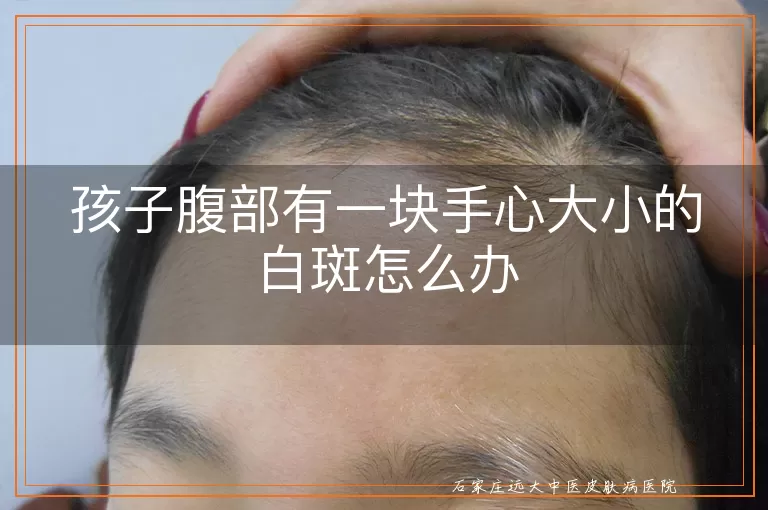 孩子腹部有一块手心大小的白斑怎么办