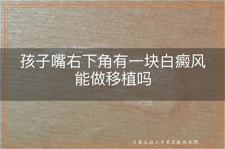 孩子嘴右下角有一块白癜风能做移植吗