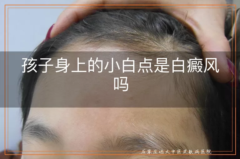 孩子身上的小白点是白癜风吗
