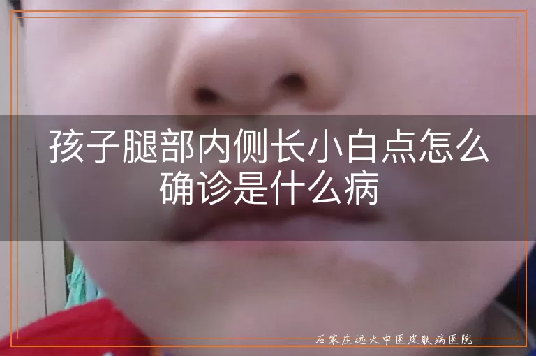 孩子腿部内侧长小白点怎么确诊是什么病