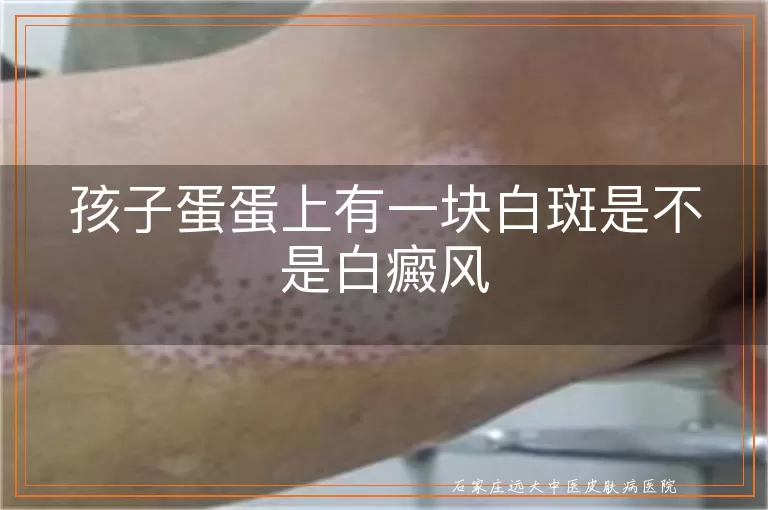 孩子蛋蛋上有一块白斑是不是白癜风