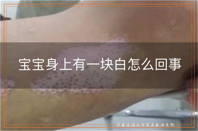 宝宝身上有一块白怎么回事