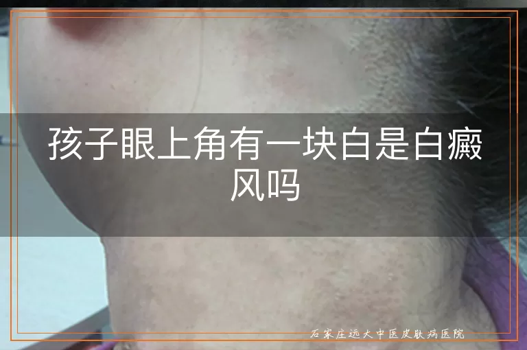 孩子眼上角有一块白是白癜风吗