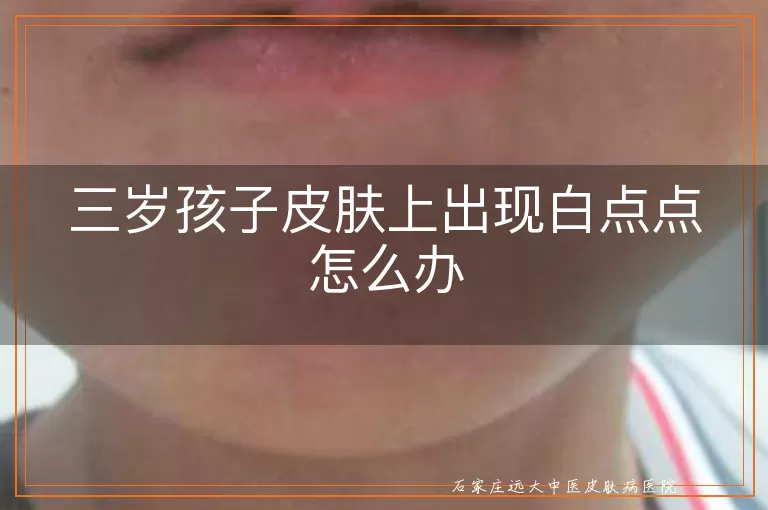 三岁孩子皮肤上出现白点点怎么办