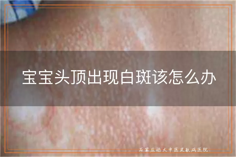 宝宝头顶出现白斑该怎么办