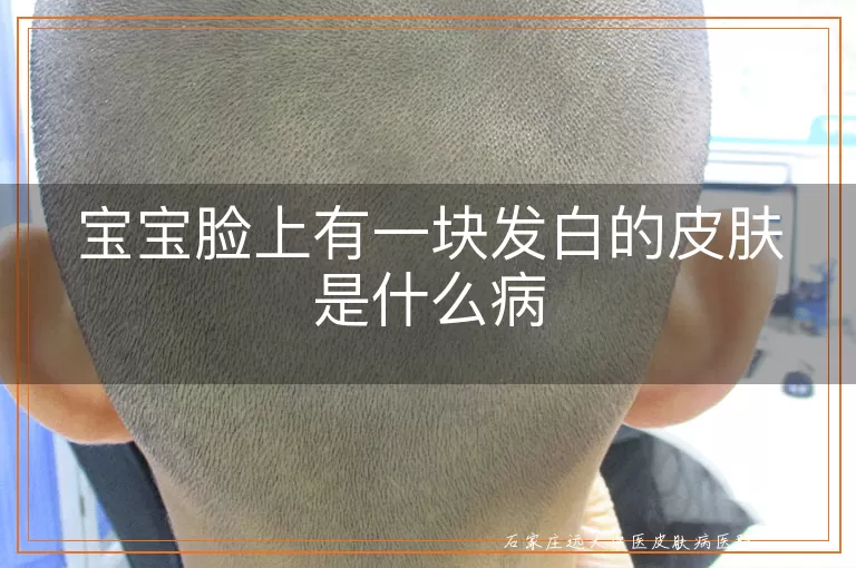 宝宝脸上有一块发白的皮肤是什么病