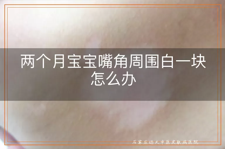两个月宝宝嘴角周围白一块怎么办