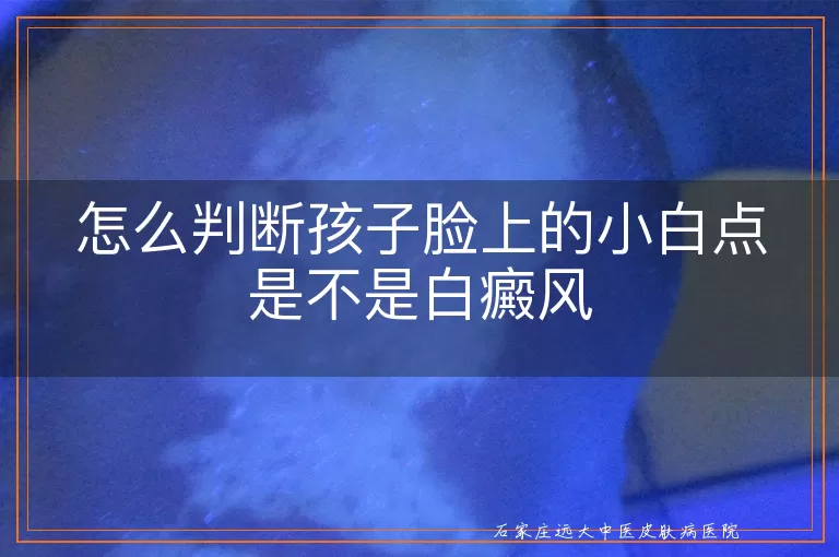 怎么判断孩子脸上的小白点是不是白癜风