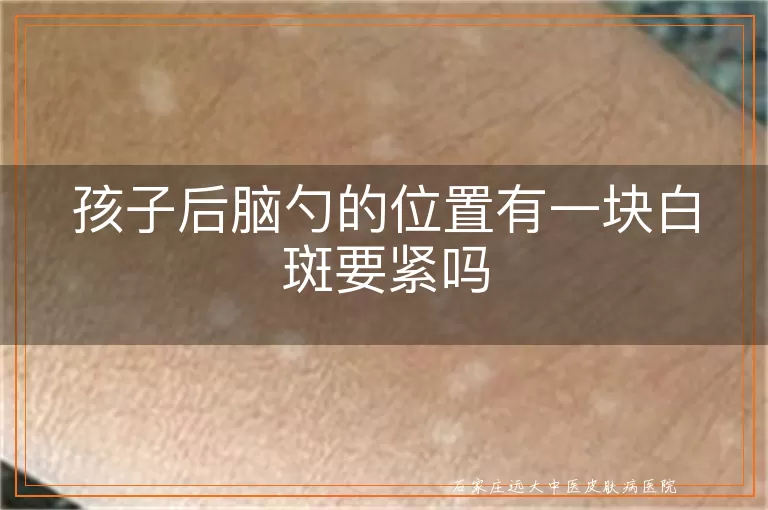 孩子后脑勺的位置有一块白斑要紧吗