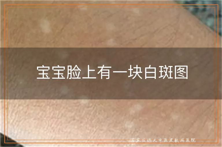 宝宝脸上有一块白斑图