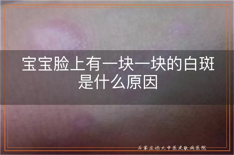宝宝脸上有一块一块的白斑是什么原因