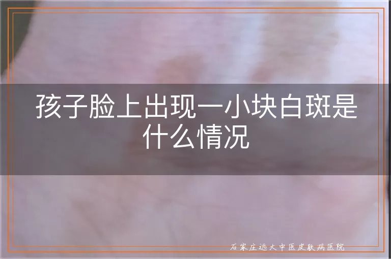 孩子脸上出现一小块白斑是什么情况