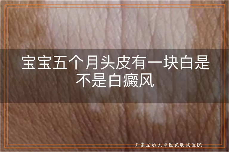 宝宝五个月头皮有一块白是不是白癜风