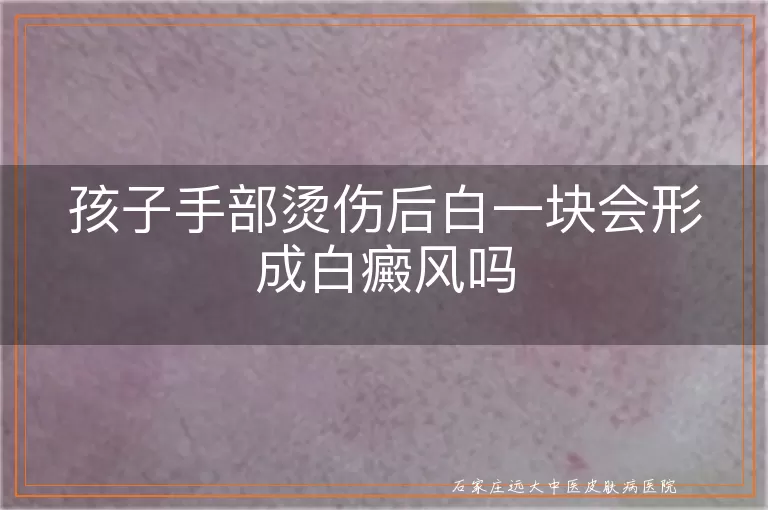 孩子手部烫伤后白一块会形成白癜风吗