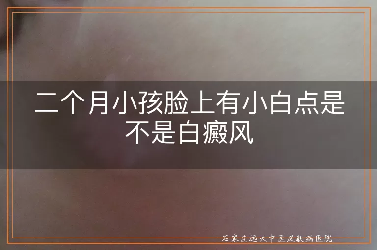 二个月小孩脸上有小白点是不是白癜风