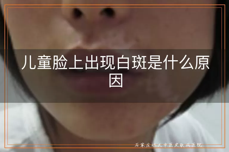 儿童脸上出现白斑是什么原因