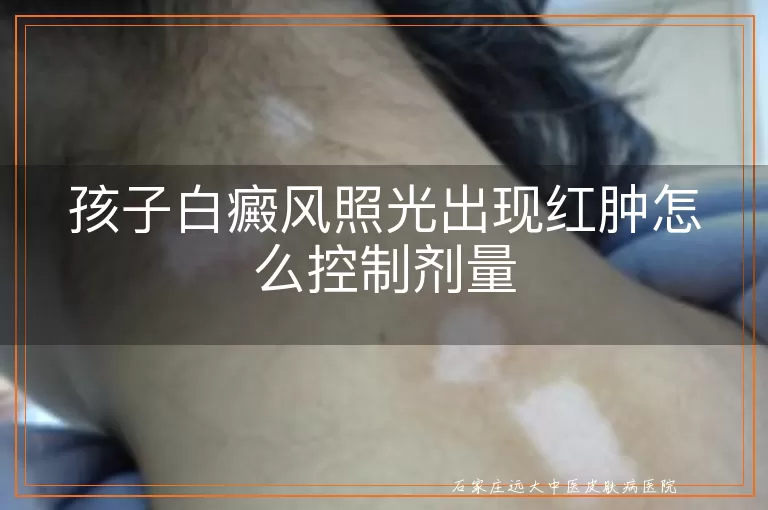 孩子白癜风照光出现红肿怎么控制剂量