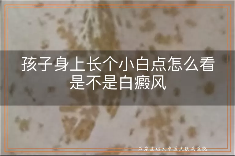 孩子身上长个小白点怎么看是不是白癜风