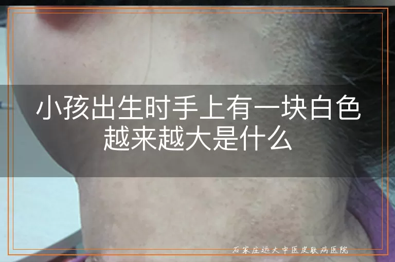 小孩出生时手上有一块白色越来越大是什么