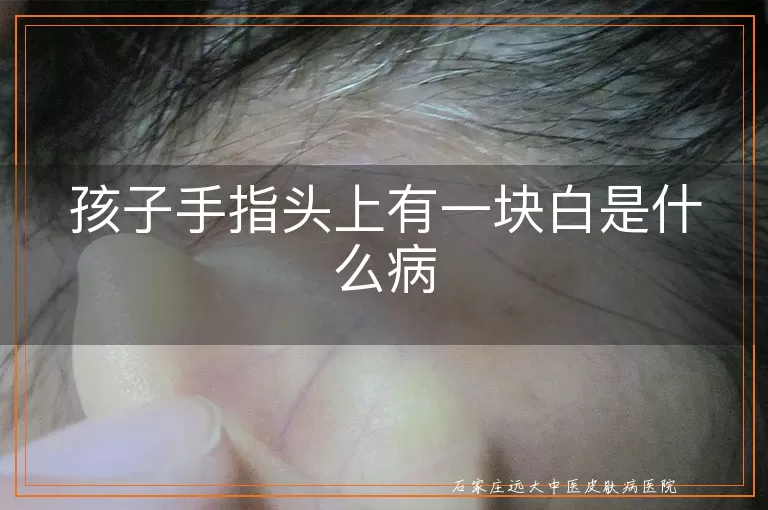 孩子手指头上有一块白是什么病