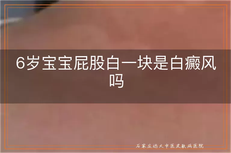 6岁宝宝屁股白一块是白癜风吗