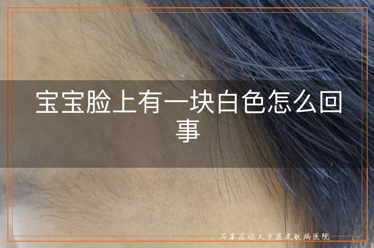 宝宝脸上有一块白色怎么回事