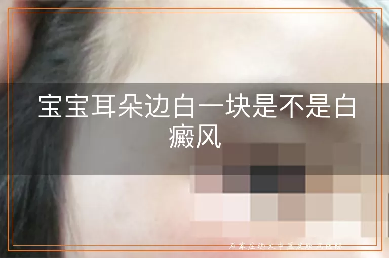宝宝耳朵边白一块是不是白癜风