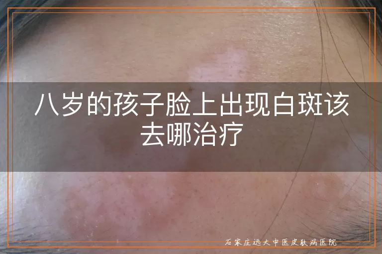 八岁的孩子脸上出现白斑该去哪治疗